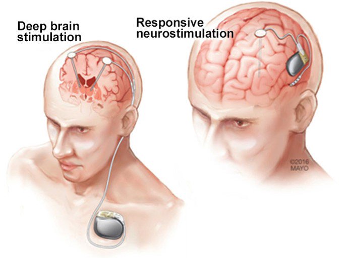 Deep brain. Brain stimulation. Deep Brain stimulation. Brain stimulation Deep у детей с ДЦП.