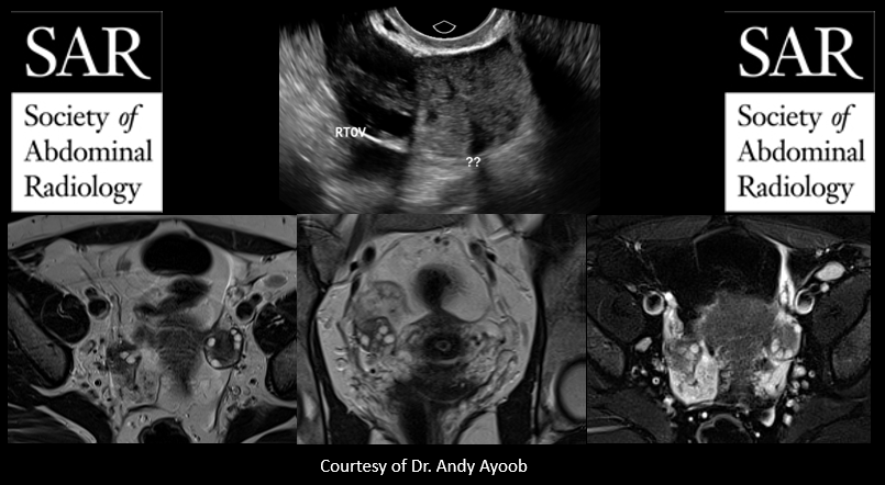 SocietyAbdRad's tweet photo. Borderline Serous Surface Papillary Tumor of the right ovary.  You are amazing!!! Great work!  Another challenging case tomorrow! https://t.co/jMkukEHX0y