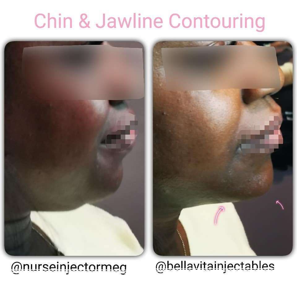 NVBeautytweets's tweet image. Ancaster’s Best Kept Secret – Facial and Jaw line slimming: Bella Vita Injectables nvbeautyboutique.com/2019/09/ancast…