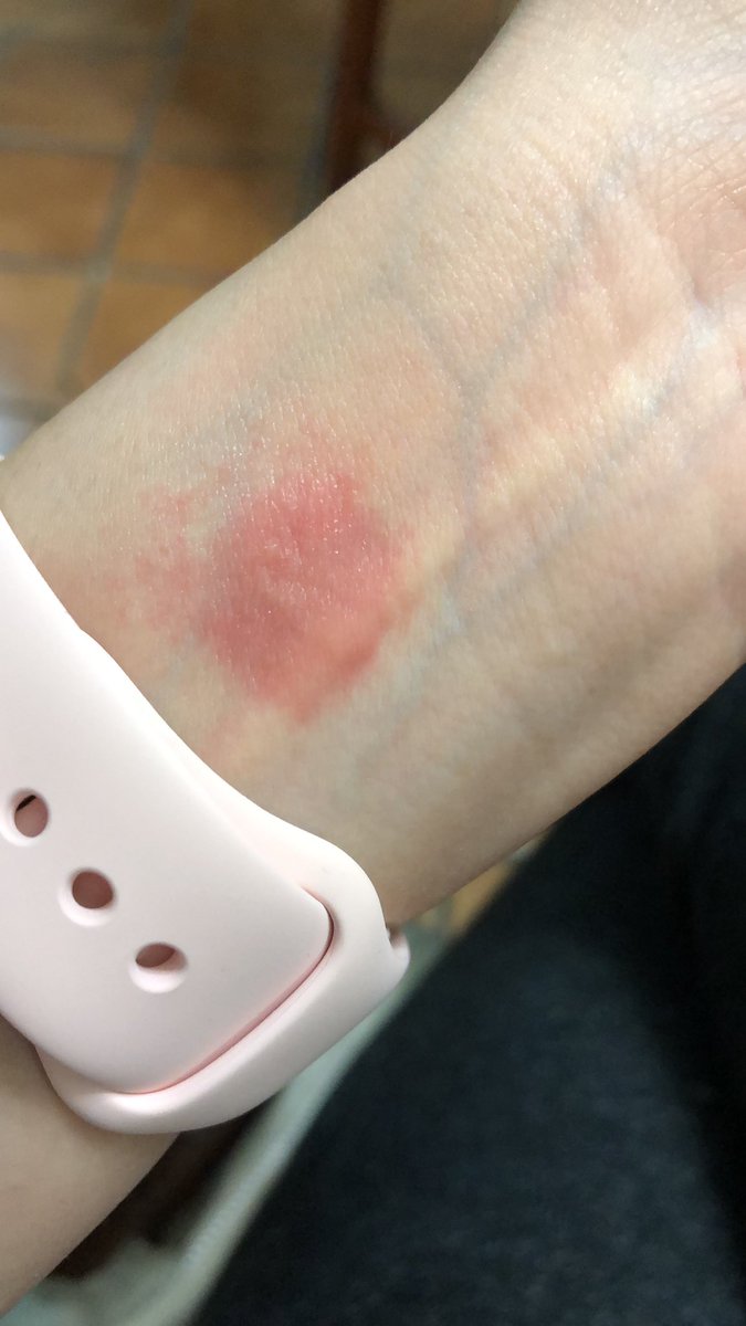 LuzzSA's tweet photo. @Apple I’m being physically abuse by my Apple Watch ⌚️... this is so sad! That metal thing on the back is not the best. https://t.co/XPQXUui8ay