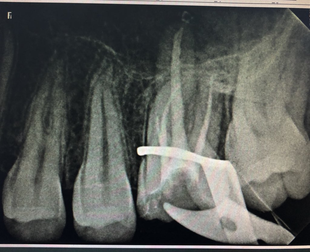 Endo Tx for upper #26                                Pulpal diagnosis :necrotic pulp periapical diagnosis :SAP           started at first as 3 canals by the 3rd vist Mb2 was found .                 Cleaning andShaping done using  protapernext files  #reu @RiyadhElmU_Hosp