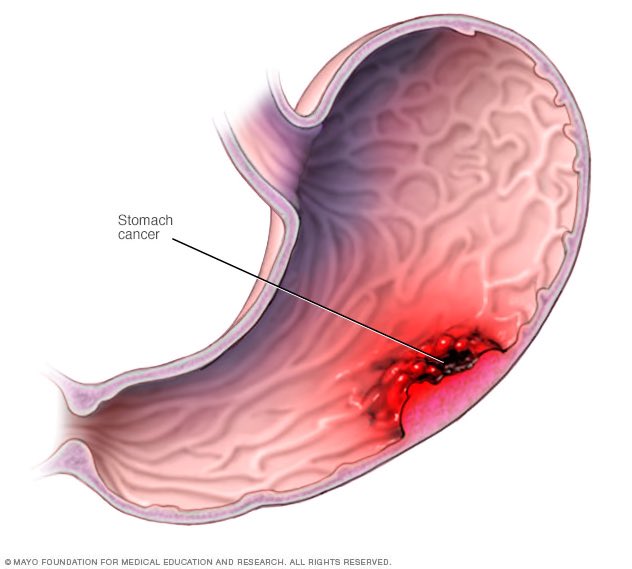 oegf98's tweet photo. 6. Neoplasias (polipos/cancer):
Virtualmente, cualquier neoplasia puede ocasionar en el tracto GI, incluyendo adenocarcinomas, tumores estromales, linfomas y sarcomas de Kaposi. https://t.co/LKLN0b4yOj