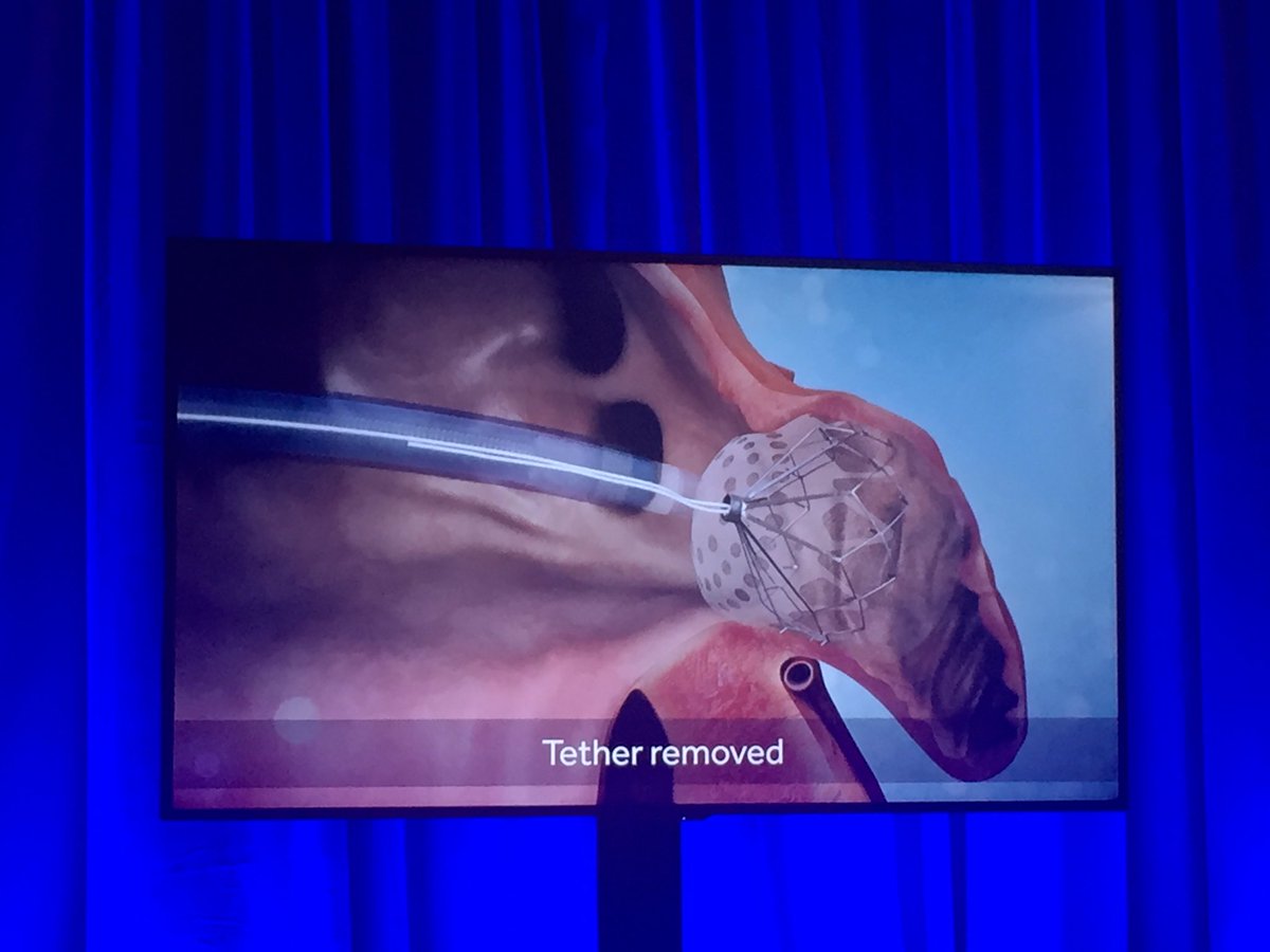 Ortega_Paz's tweet photo. #TCT2019 #LAOO device for non usual LAO anatomy @PCRonline https://t.co/NjBEFtg6ut
