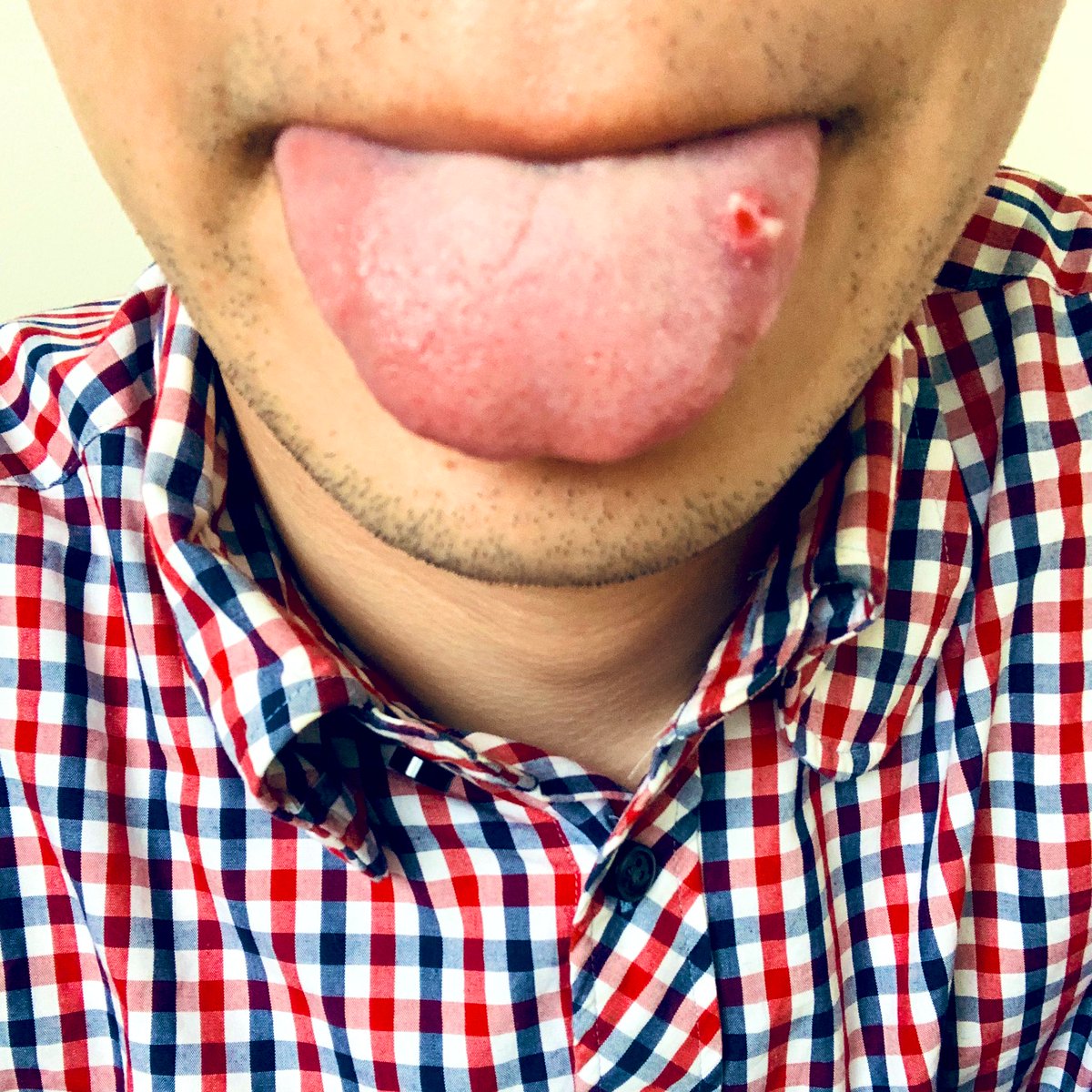 噛ん 痛い 舌 だ 舌を噛む原因とは？何度も繰り返す理由や対処方法について