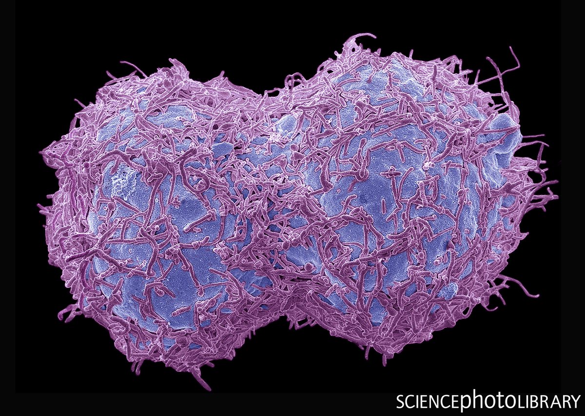 Captured during the third stage of mitotic cell division, this SEM shows breast  cancer cells during anaphase. Credit: Steve Gschmeissner \u0026 Keith Chambers /  Science Photo Library https://t.co/IYzQb5Km9k #science #breastcancer #cancer  #malignant #, image size:1200x853