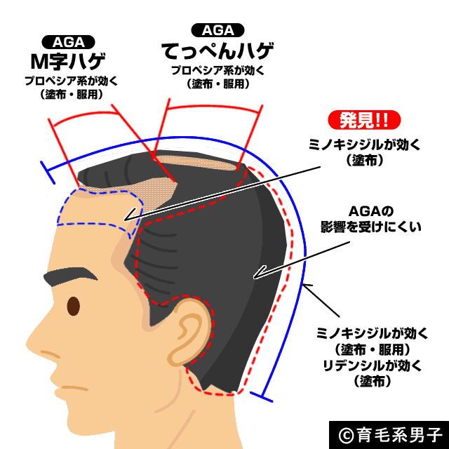 ミノキシジル プロペシア