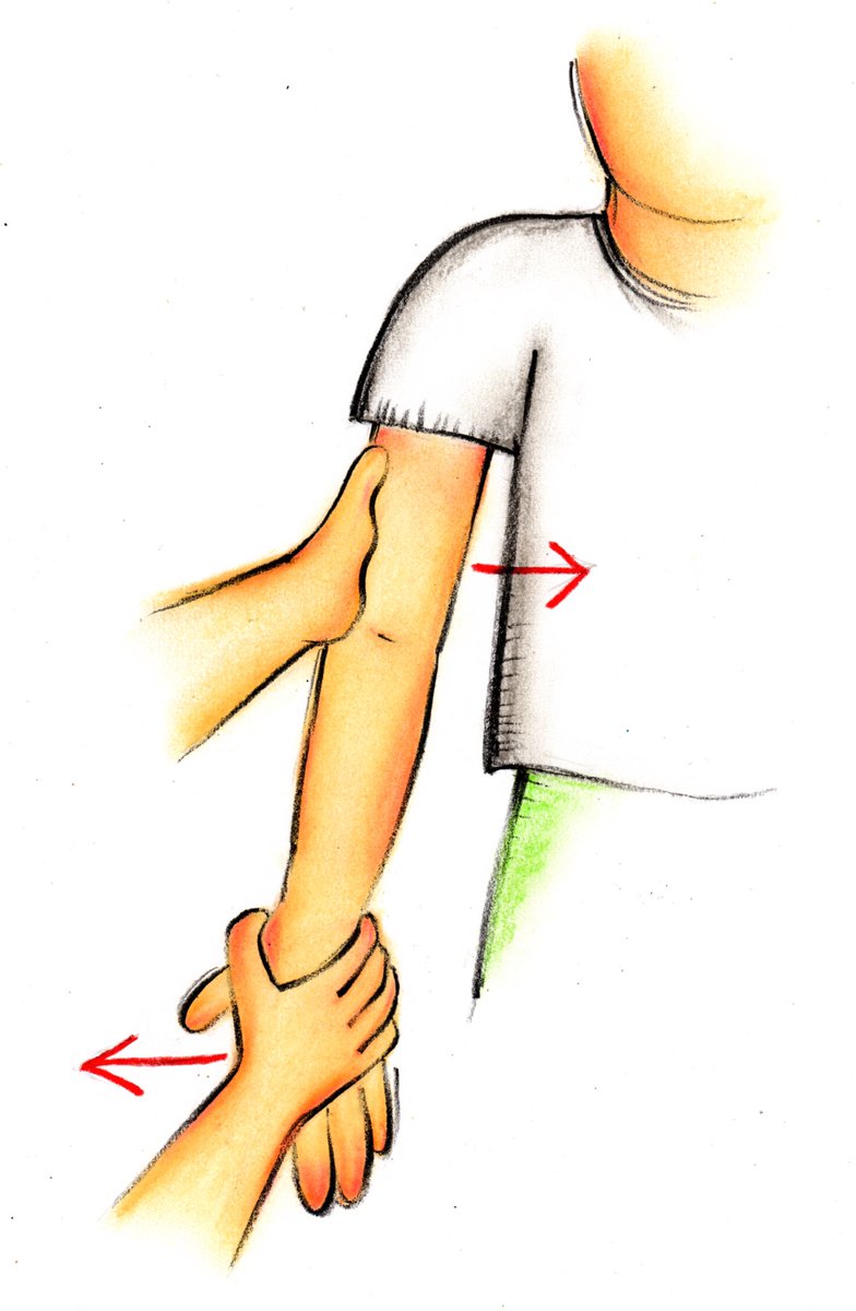 トレシピ 外傷性外側側副靭帯損傷 肘 検査 内反ストレステストは 肘を真っ直ぐ伸ばした状態で 片方の手で肘関節を固定し もう一方の手で手首を矢印の方向に動かします 痛みが出たら陽性です T Co Ot6rpegi4j