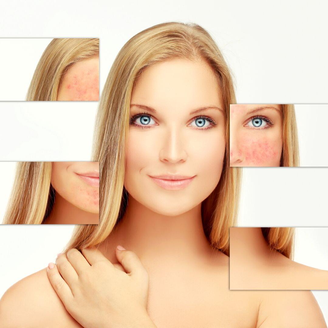 Health_Local's tweet image. Acne Myth #1: Eating Chocolate Gives you Acne.

The controversy over diet and how it relates to acne, continues. Although some studies have suggested that ...

instagram.com/p/B24FQYRHV1I/

#clearskin #skincare #sharewithme #skincareawarenessmonth