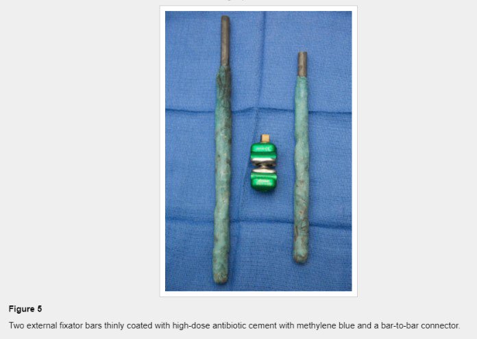 ArthroToday's tweet photo. How to implant and remove an external fixator arthrodesis antibiotic spacer "as an alternative to the traditional static spacer" for knee stability, bone loss prevention, and soft-tissue care during the spacer phase. #kneearthroplasty
https://t.co/hGrC8RqOPL https://t.co/ou1v74e2ge