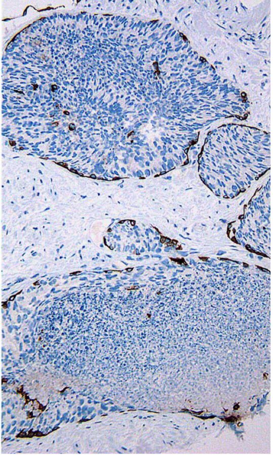 Selamete3's tweet photo. 🔬Intraductal Carcinoma of the Prostate🔬
#Solid pattern of IDC-P showing malignant cells with central necrosis contained within an intact basal cell layer(A).
#Cribriform pattern of IDC-P showing large branched glands containing central necrosis and calcification(B).
#AB p63 https://t.co/Ma7psqNkNe