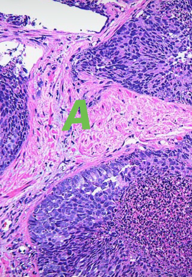 Selamete3's tweet photo. 🔬Intraductal Carcinoma of the Prostate🔬
#Solid pattern of IDC-P showing malignant cells with central necrosis contained within an intact basal cell layer(A).
#Cribriform pattern of IDC-P showing large branched glands containing central necrosis and calcification(B).
#AB p63 https://t.co/Ma7psqNkNe