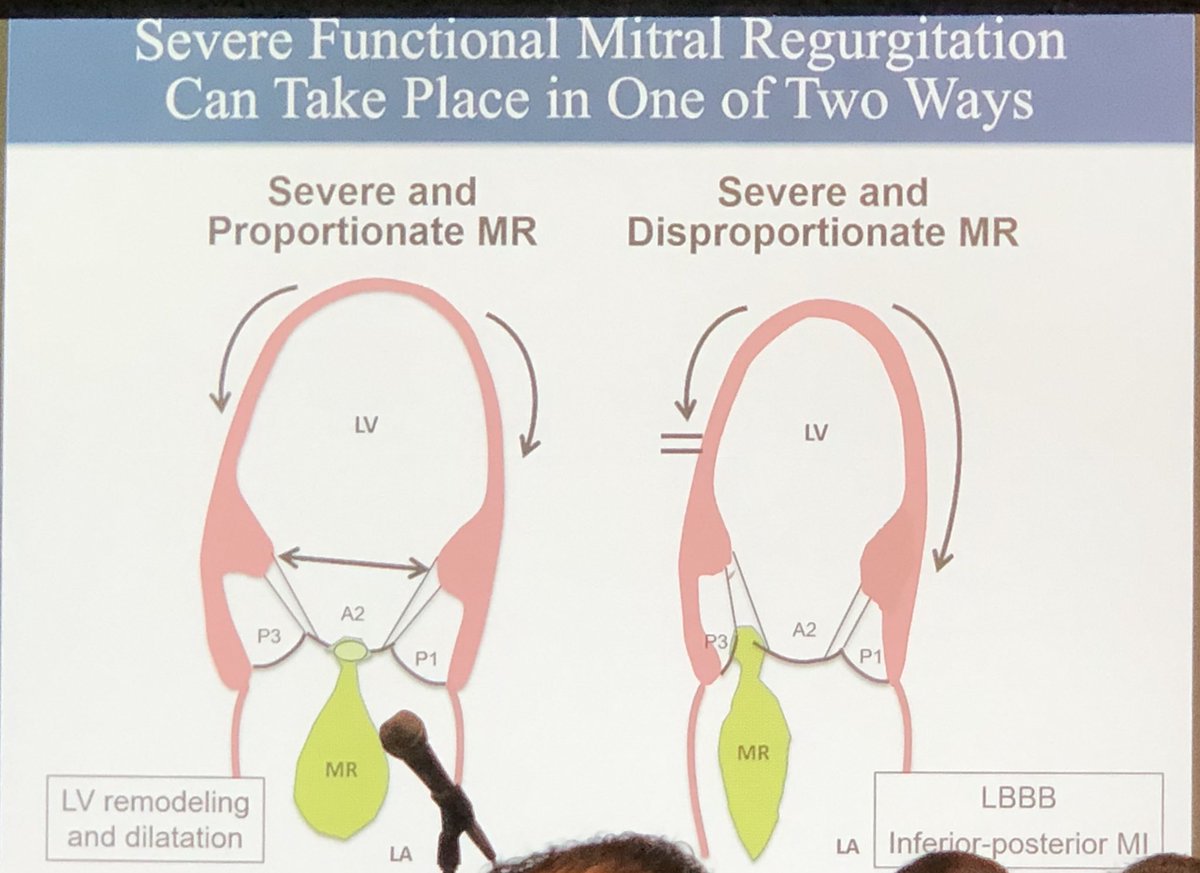 DrVivianNg's tweet photo. When should patients should get MV vs. LV therapy? Dr. Milton Packer explains
💥MR that is proportionate vs disproportionate to LV dilation are 2 diff entities
💥Disprop. MR benefits from MV therapy
💥Prop. MR should get HF/LV therapy
#TCT2019 #SHD @crfheart https://t.co/GOneFbKUFh
