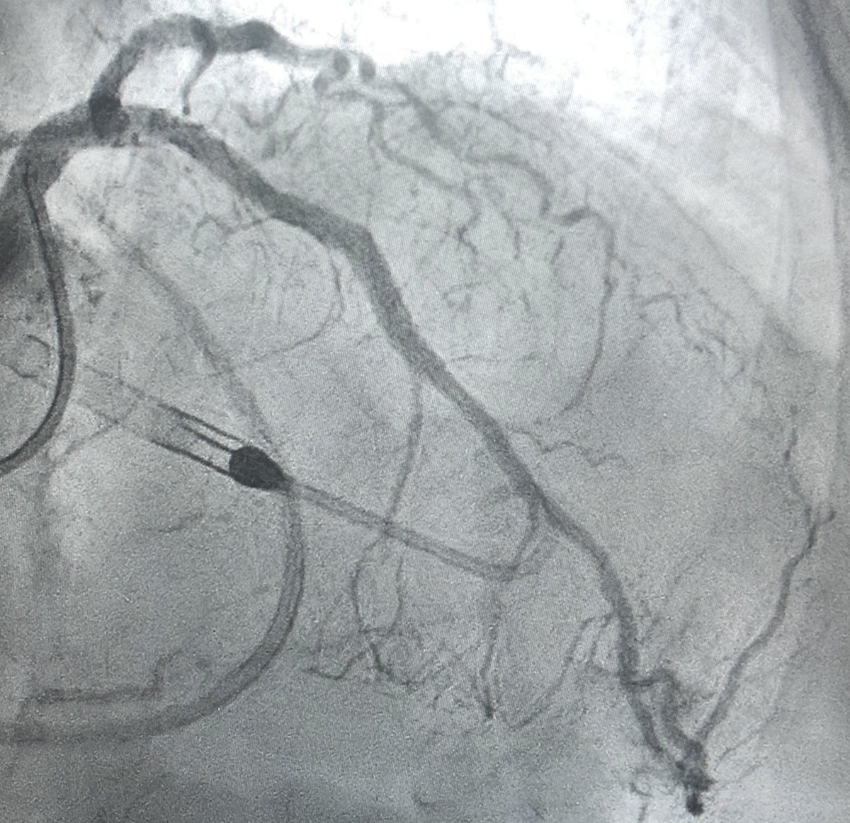 agtruesdell's tweet image. 3/3 👍Initial LVEDP 30. #PercAx Impella. IVUS-guided/optimized #RadialFirst #LDTRA LAD/LCX PCI/Rota/DES (with deferral of RCA CTO for staging later)...