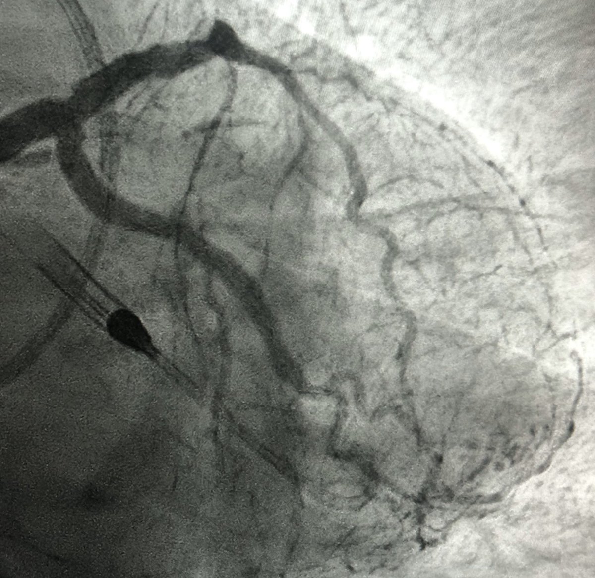 agtruesdell's tweet image. 3/3 👍Initial LVEDP 30. #PercAx Impella. IVUS-guided/optimized #RadialFirst #LDTRA LAD/LCX PCI/Rota/DES (with deferral of RCA CTO for staging later)...