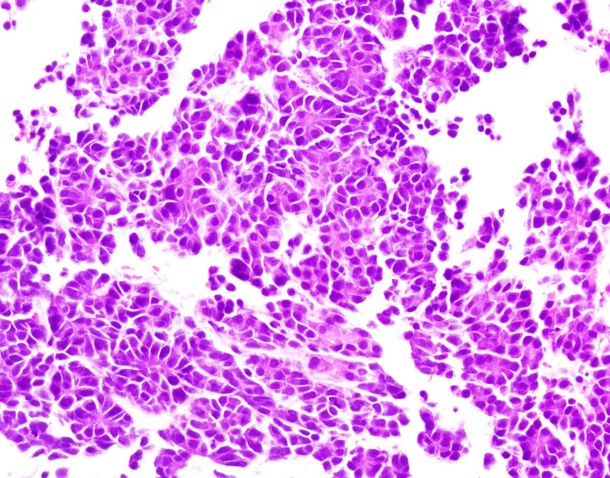 Ami Patel (@apatelpath) on Twitter photo First time seeing this one! 3 month old with Hepatoblastoma #cytology #pathology #Pediatrics @doc_kartik <a href="/JASCJOURNAL/">Journal of American Society of Cytopathology</a> <a href="/WCMCPathology/">Weill Cornell Medicine Pathology</a> <a href="/PCubedMD/">Priya P. Patel</a> <a href="/CancerCytopath/">Cancer Cytopathology</a> First time seeing this one! 3 month old with Hepatoblastoma #cytology #pathology #Pediatrics @doc_kartik <a href="/JASCJOURNAL/">Journal of American Society of Cytopathology</a> <a href="/WCMCPathology/">Weill Cornell Medicine Pathology</a> <a href="/PCubedMD/">Priya P. Patel</a> <a href="/CancerCytopath/">Cancer Cytopathology</a>