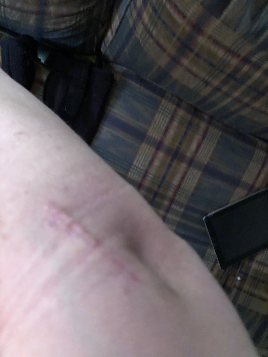 mcgaula's tweet image. Swelling has gone down some. Still have some edema around the joint. I hated to put that ace wrap on but....#elbowsurgery #bonespurremovalx3 #openapproach #