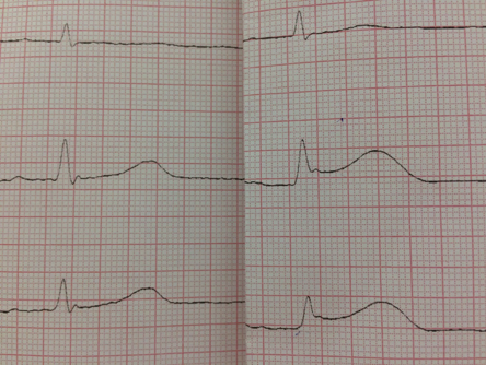 GERpocus's tweet photo. Wer hatte noch mal in Berlin Anfang des Jahres diese schöne STEMI-Dynamik eingefangen? Nutze es in meinem ACS-Vortrag und will die Quelle angeben.
#foamed
#dasFOAM
#foamEKG https://t.co/lv0M3PYNeG