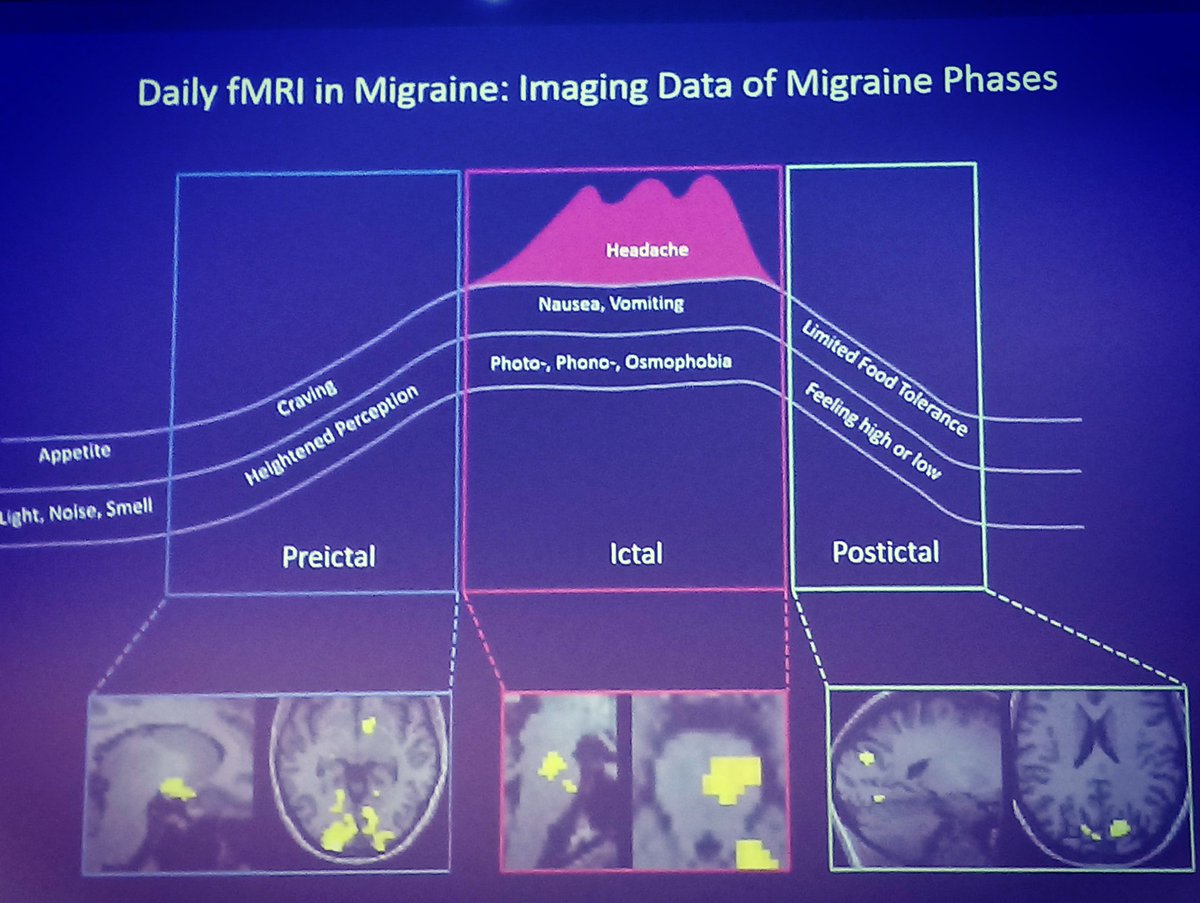 ihs_official's tweet photo. Brain image during migraine attack is fascinating and revealing!  #tbt #mtis2018 #london #neurology #migraine #PAM2019 #PainAwarenessMonth 
By Dr Laura Schulte @HH_HRC https://t.co/3j3YiygcZ7