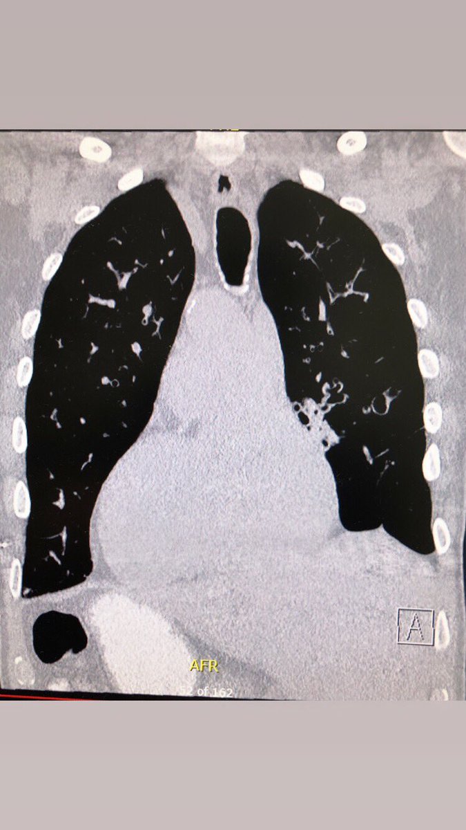 Ahmed Bakhshwin (@ahmed_bakhshwin) on Twitter photo Just had a nice case of Kartagener's syndrome with complete situs inversus and lungs with extensive broncheactesis. <a href="/smlungpathguy/">Sanjay Mukhopadhyay</a> <a href="/fridobruehl/">Frido Bruehl</a> <a href="/DrMNichols/">Meredith Nichols, MD</a> Just had a nice case of Kartagener's syndrome with complete situs inversus and lungs with extensive broncheactesis. <a href="/smlungpathguy/">Sanjay Mukhopadhyay</a> <a href="/fridobruehl/">Frido Bruehl</a> <a href="/DrMNichols/">Meredith Nichols, MD</a>