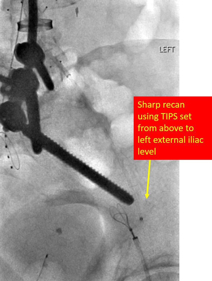 Osman Ahmed (@therealdoctoros) on Twitter photo Utilizing Hybrid Angiography-CT to recanalize a surgically ligated left iliac vein from prior lumbar surgery. Sharp recan + CT guided gunsight technique FTW. Great case with my partner Dr Leef and <a href="/DivyaKumariMD/">Divya Kumari</a> #DVTfree 🙏🏽🤲🏽 (more pics in comments) Utilizing Hybrid Angiography-CT to recanalize a surgically ligated left iliac vein from prior lumbar surgery. Sharp recan + CT guided gunsight technique FTW. Great case with my partner Dr Leef and <a href="/DivyaKumariMD/">Divya Kumari</a> #DVTfree 🙏🏽🤲🏽 (more pics in comments)