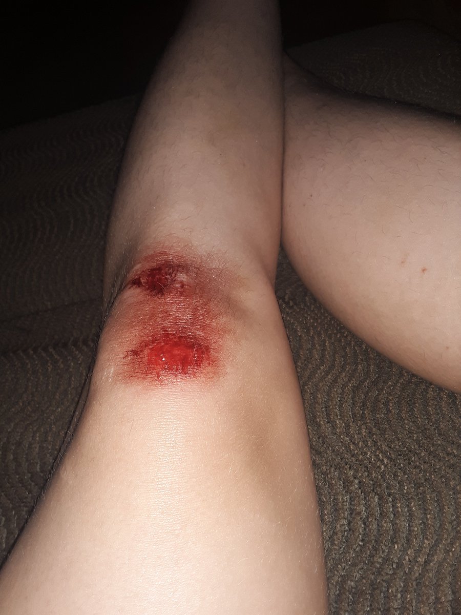 ShawnaHash's tweet image. I may or may not be the first adult to draw blood at the new park in town...