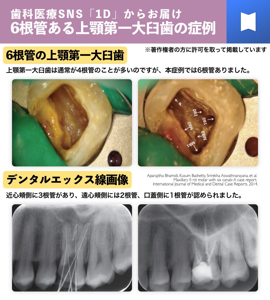 6根管ある上顎第一大臼歯の症例を、歯科医療者専用のSNS「1D」からお
