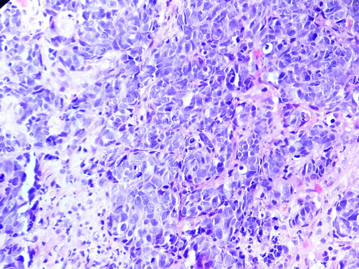 Ho_Khanh_MD's tweet photo. #pulmpath #pathology
Liver bx, multiples lesions. Ctx of lung nodule. How would you type this carcinoma ?
IHC : TTF1-, napsinA-, keratin5 partially+, p40-, focal + of synapto and INSM1, chromo-
@smlungpathguy @yro854 @lara_pijuan @MelanieBoisMD @ariella8 @TheKarenPinto @DrGeeONE https://t.co/g45hyN9Xk7