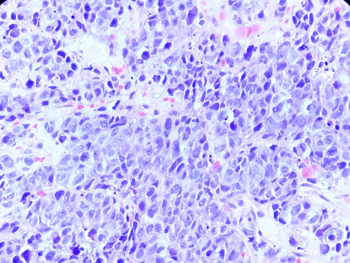 Ho_Khanh_MD's tweet photo. #pulmpath #pathology
Liver bx, multiples lesions. Ctx of lung nodule. How would you type this carcinoma ?
IHC : TTF1-, napsinA-, keratin5 partially+, p40-, focal + of synapto and INSM1, chromo-
@smlungpathguy @yro854 @lara_pijuan @MelanieBoisMD @ariella8 @TheKarenPinto @DrGeeONE https://t.co/g45hyN9Xk7