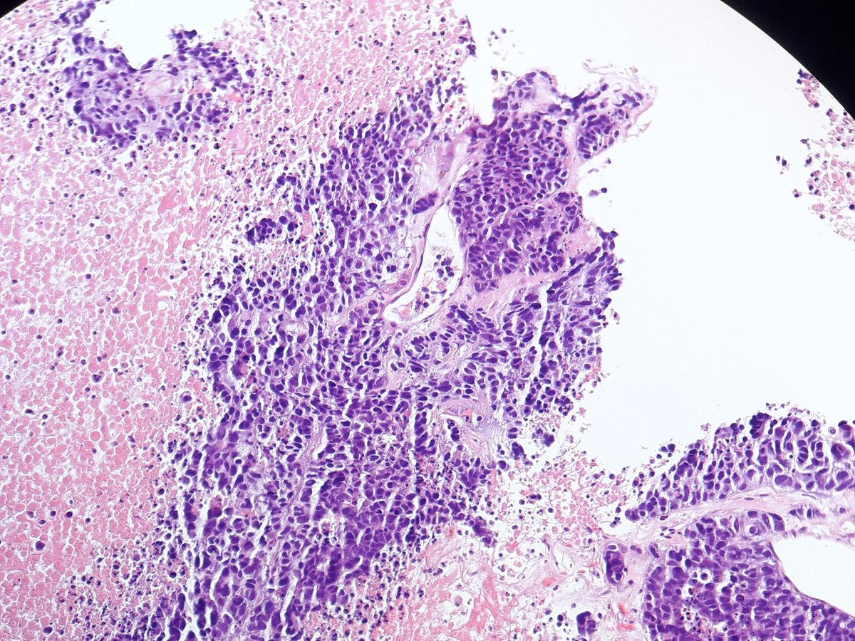 Ho_Khanh_MD's tweet photo. #pulmpath #pathology
Liver bx, multiples lesions. Ctx of lung nodule. How would you type this carcinoma ?
IHC : TTF1-, napsinA-, keratin5 partially+, p40-, focal + of synapto and INSM1, chromo-
@smlungpathguy @yro854 @lara_pijuan @MelanieBoisMD @ariella8 @TheKarenPinto @DrGeeONE https://t.co/g45hyN9Xk7