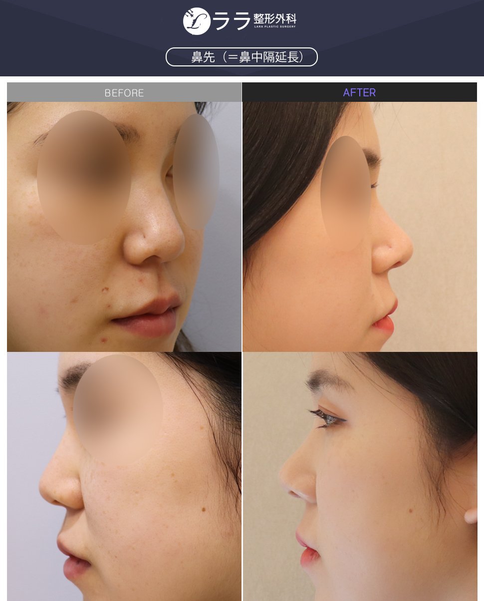 ララ美容整形外科 人工保形物に対する拒否感があるけど 鼻の整形はしたい と思う方に お勧めする 鼻先のみの整形 です ララ の鼻先手術は 鼻中隔延長術 を意味します 普通の場合 本人の鼻の内側にある鼻中隔軟骨だけで 丈夫な ララ美容整形外科 人工保形物に対する拒否感があるけど 鼻の整形はしたい と思う方に お勧めする 鼻先のみの整形 です ララ の鼻先手術は 鼻中隔延長術 を意味します 普通の場合 本人の鼻の内側にある鼻中隔軟骨だけで 丈夫な
