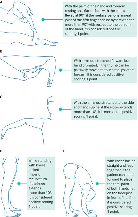 EhlersDanlos syndromes What to do if you suspect a diagnosis? Figure EhlersDanlos syndromes What to do if you suspect a diagnosis? Figure