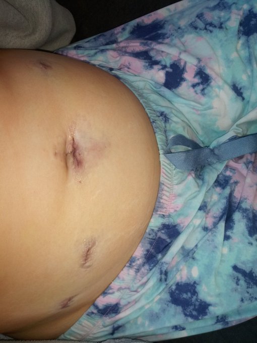 Got my gallbladder taken out yesterday and omg surgery sucks...im in so much pain right now or im a big