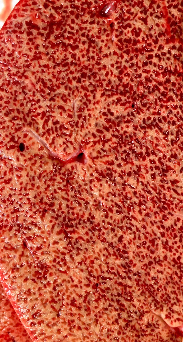 Michal Kunc Md V Twitter Congestive Hepatopathy A Nice Example Of Nutmeg Liver Hepar Moschatum Micro Centrilobular Congestion Autopsy Pathresident Https T Co Sclb6xpw97