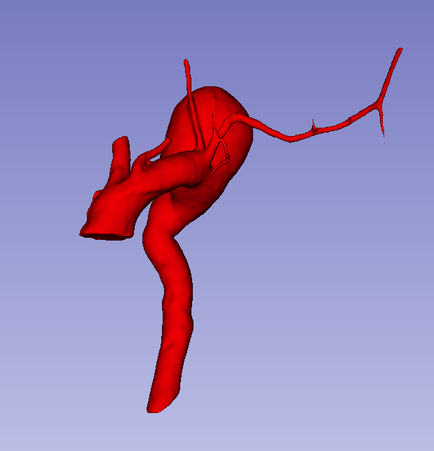 3d_maranon's tweet photo. 3D printed model of an aortic aneurysm. This model will help @javispacem planning how the intervention will take place.

Work by the Marañón FabLab Team: @rupermac @calvoharo_ja @diegotrap  @luciagds @LauraFloresBM https://t.co/XzBC21O42U