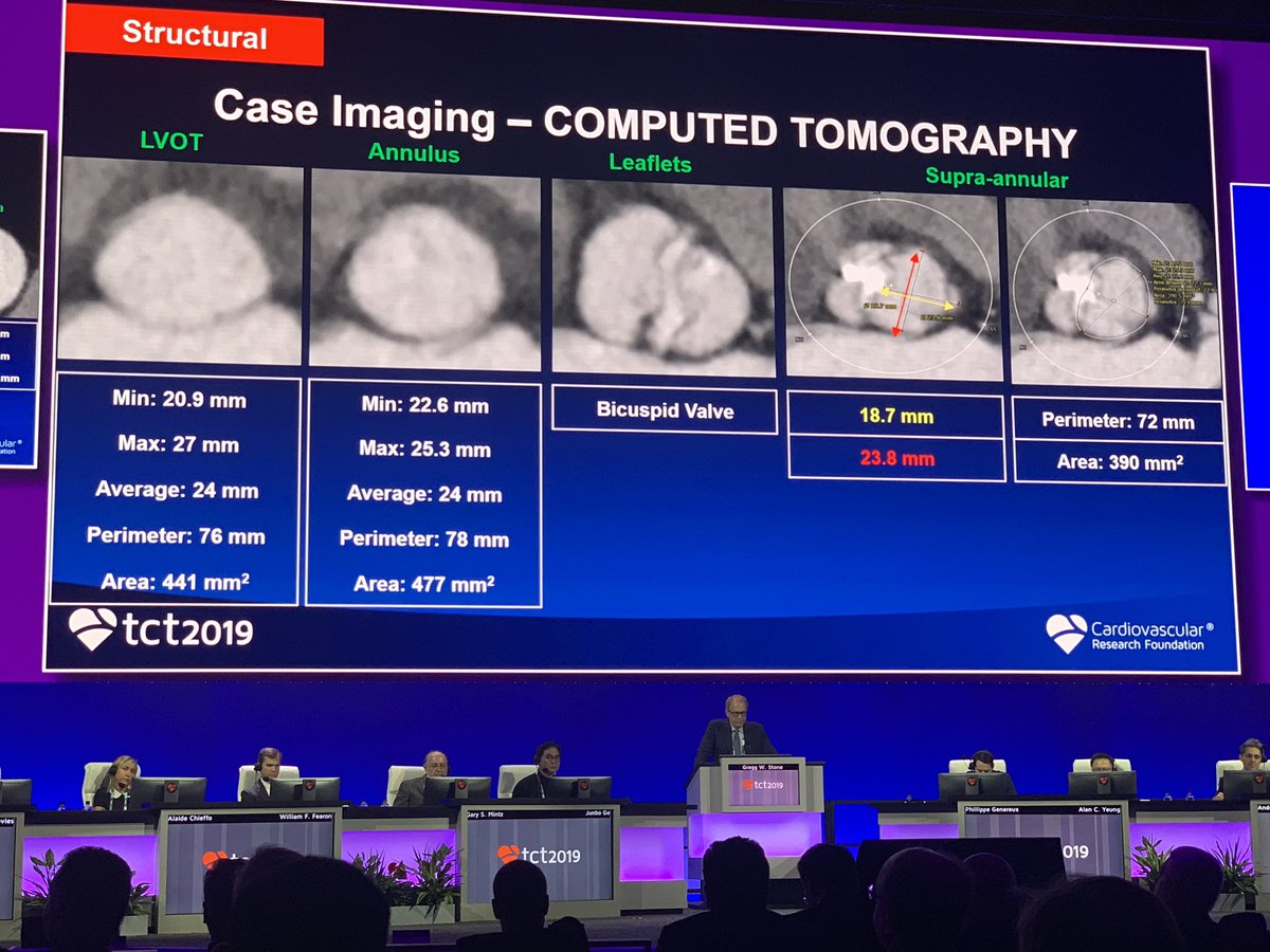 atunuguntla1's tweet photo. Live case from NYPH/CUMC Bicuspid #TAVR #Lotus valve #SusheelKodali #IsaacGeorge so many important issues being discussed! @GreggWStone @ShrillaB @mirvatalasnag @ekgpdx @RajTayal2 #TCT2019 @crfheart @TCTConference https://t.co/mpP90MT25s