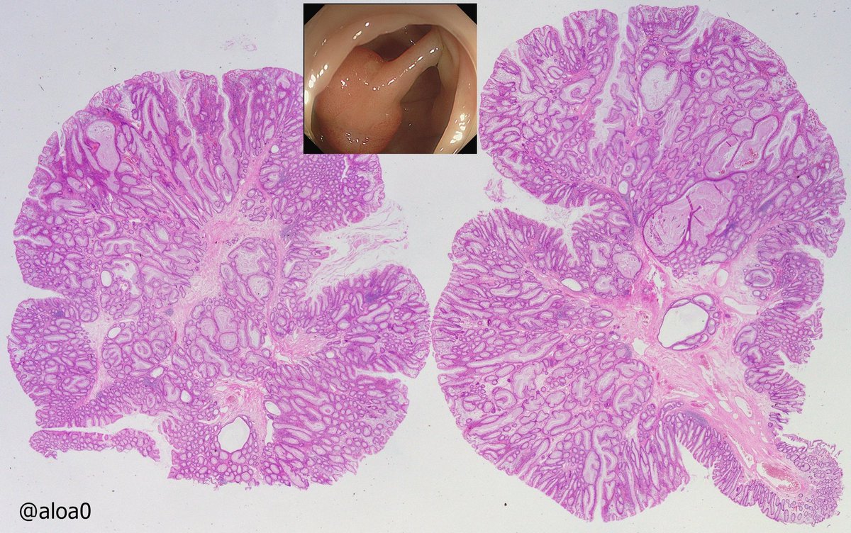 aloa0's tweet photo. 2cm pedunc polyp in D-colon, M/60 w/o polyposis. Prolif. of cystically dilated glands w some wisps of sm muscle in l.p. that is superficially inflamed.  ? IP/inflmmtry myoglandular P/muc. prolapse P #GIpath @RunjanChetty @DraEosina @RaulSGonzalezMD https://t.co/TqBd4ak7rP