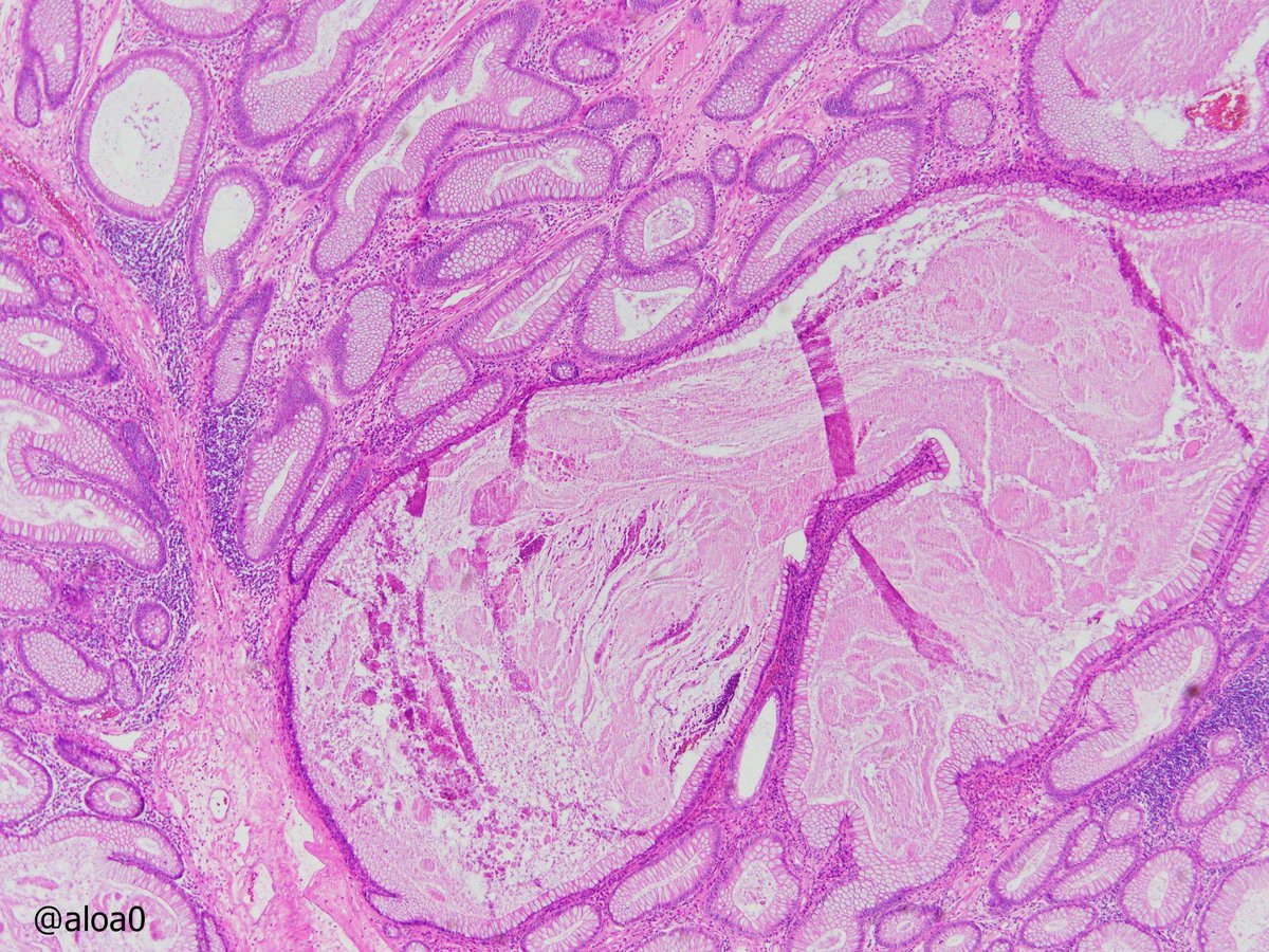aloa0's tweet photo. 2cm pedunc polyp in D-colon, M/60 w/o polyposis. Prolif. of cystically dilated glands w some wisps of sm muscle in l.p. that is superficially inflamed.  ? IP/inflmmtry myoglandular P/muc. prolapse P #GIpath @RunjanChetty @DraEosina @RaulSGonzalezMD https://t.co/TqBd4ak7rP