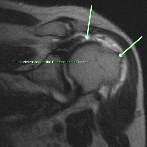 DrPomeranz's tweet photo. Rotator Cuff Tear - MRI Online https://t.co/y1GoA8OMwE

The rotator cuff is a stabilizing group of muscles (teres minor supraspinatus infraspinatus and subscapularis) and tendons which approximate each other along their insertion sites to the humeral head.

#ShoulderMRI #MSK https://t.co/dc7kcljhO7
