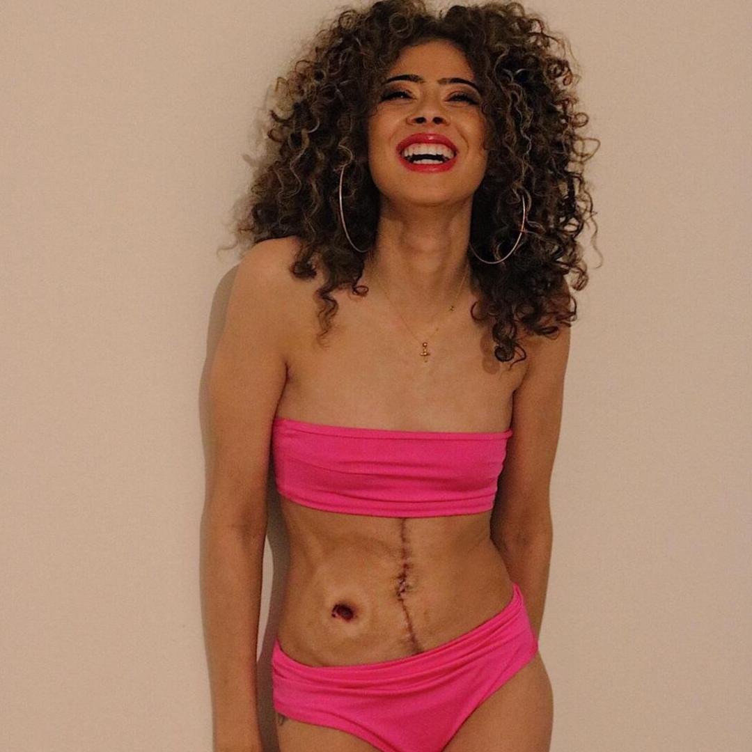 Ileostomy Reversal Scar