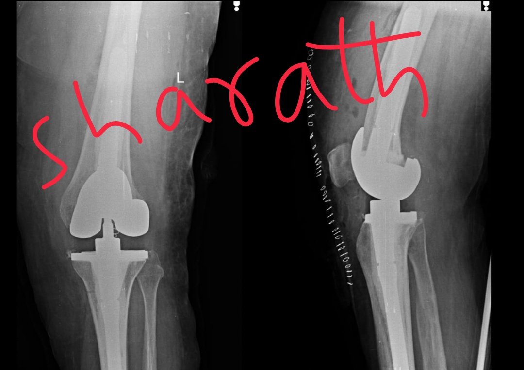 RamanathSharath's tweet photo. Properly sized ,well cemented and accurately aligned #revisiontkr using #LCCK ( #constrainedcondylarprosthesis).
#tkr #RMH #SHARATH #ramaiahhospital #kneesurgeon https://t.co/iOdRSXXp4E