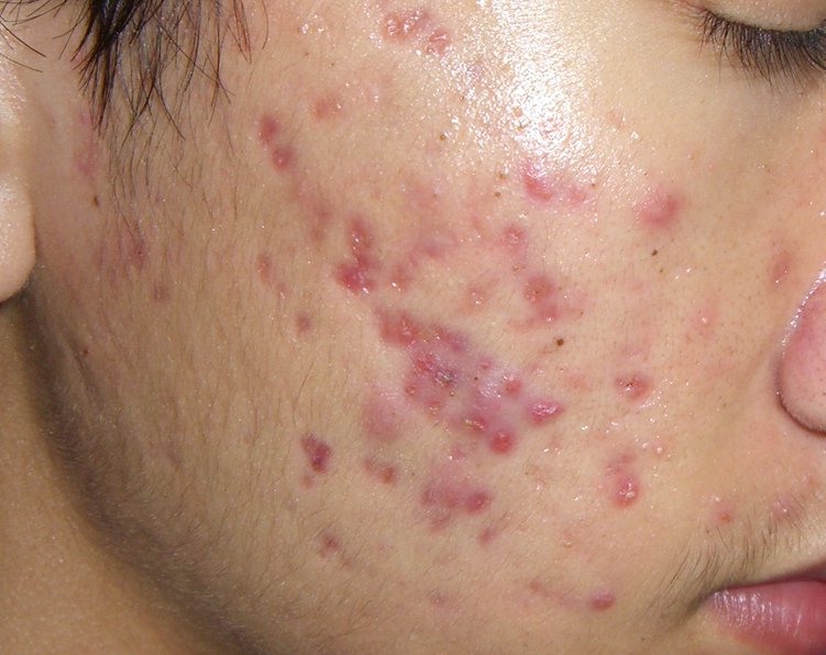 HqImagic's tweet photo. Lelaki pon boleh tau!!Ingat perempuan je ke ada masalah kulit ? sebelum tido,cuci muka,pakai toner jangan lupa pakai IMAGIC SERUM tau..esok bangun jerawat TERUS KECUT macam magic..#hilangparut #hilangjerawat #hilangjeragat #serumviral #imagictreatmentserum  #jerawatkecut https://t.co/4t9zv3U8Ab