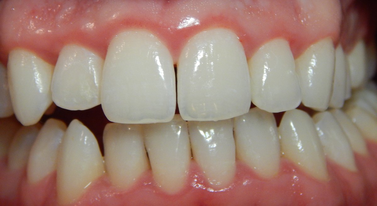 Bleeding gums are a sign of #gingivitis, or #inflammation of your gums. It's a common and mild form of gum disease, and it's caused by a buildup of plaque at your gumline.
#admiredental #springfieldma #dentist #oralhealth #teeth #smile