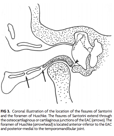 TheAJNR's tweet photo. Get ready for #ASHNR19 with this #HNrad article from the most recent issue of AJNR:

A Persistent Foramen of Huschke: A Small Road to Misery in Necrotizing External Otitis | https://t.co/U626NNPQEV #NeuroRad @ASHNRSociety https://t.co/yLcbSbqAMY