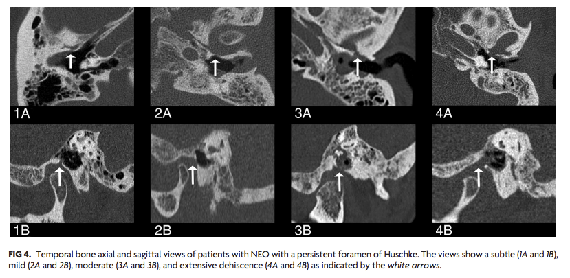 TheAJNR's tweet photo. Get ready for #ASHNR19 with this #HNrad article from the most recent issue of AJNR:

A Persistent Foramen of Huschke: A Small Road to Misery in Necrotizing External Otitis | https://t.co/U626NNPQEV #NeuroRad @ASHNRSociety https://t.co/yLcbSbqAMY