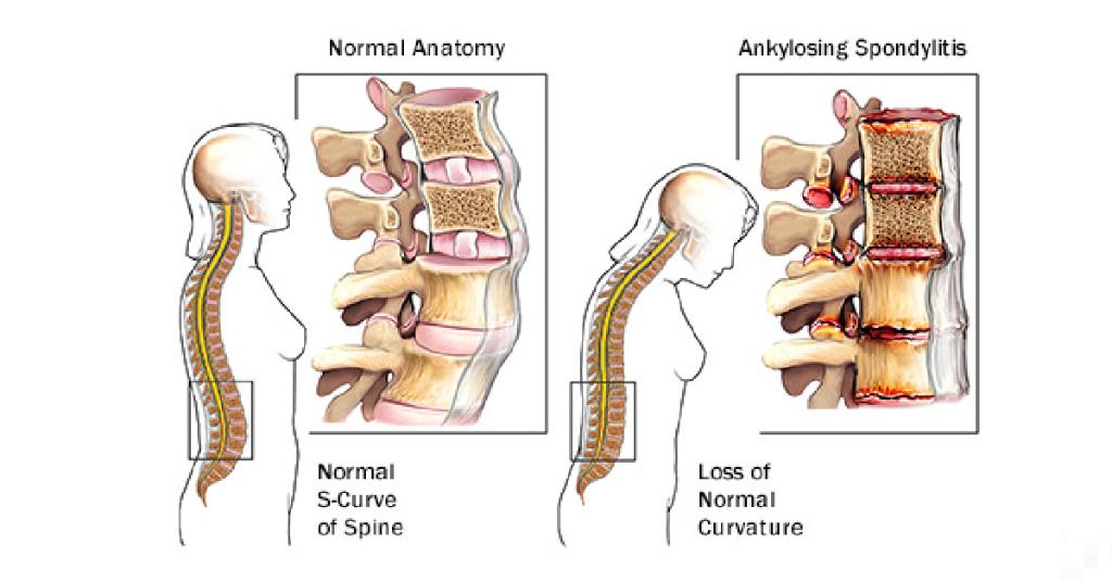 Что такое болезнь бехтерева простыми словами. Анкилозирующий спондилит Бехтерева. Анкилозирующий спондилит болезнь Бехтерева. Анкилозирующий спондилит (болезнь Бехтерева) распространенность. Болезнь Бехтерева мрт позвоночника.