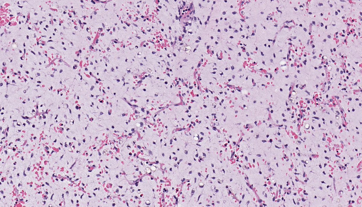 B_C_Dickson's tweet photo. MYXOID LIPOSARCOMA. NGS: FUS-DDIT3. NB: spindle-stellate cells set within abundant myxoid stroma; pools of extracellular mucin with a so-called 'pulmonary oedema' pattern; delicate branching vasculature; scattered small lipoblasts. https://t.co/oB2ud5ZkQJ