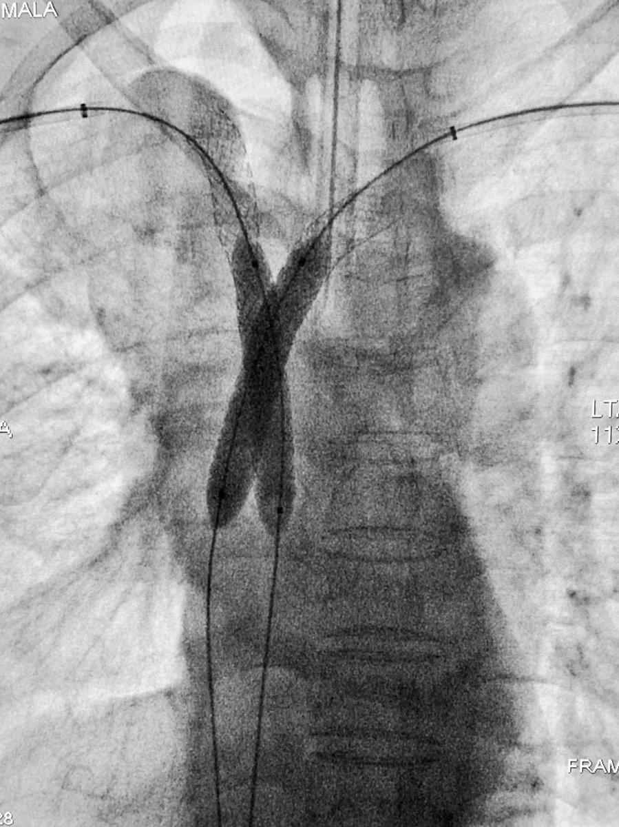 t_intheleadcoat's tweet photo. SVC syndrome due to invasive lung malignancy treated with kissing VBX stents. #irad #svcsyndrome #stentgraft #cancer #venogram #CTVO #swelling #palliation #VBX #pancoasttumor @womenirads @pairsmedia @io_meet @CIO_Oncology https://t.co/Lwj4WZwkkg