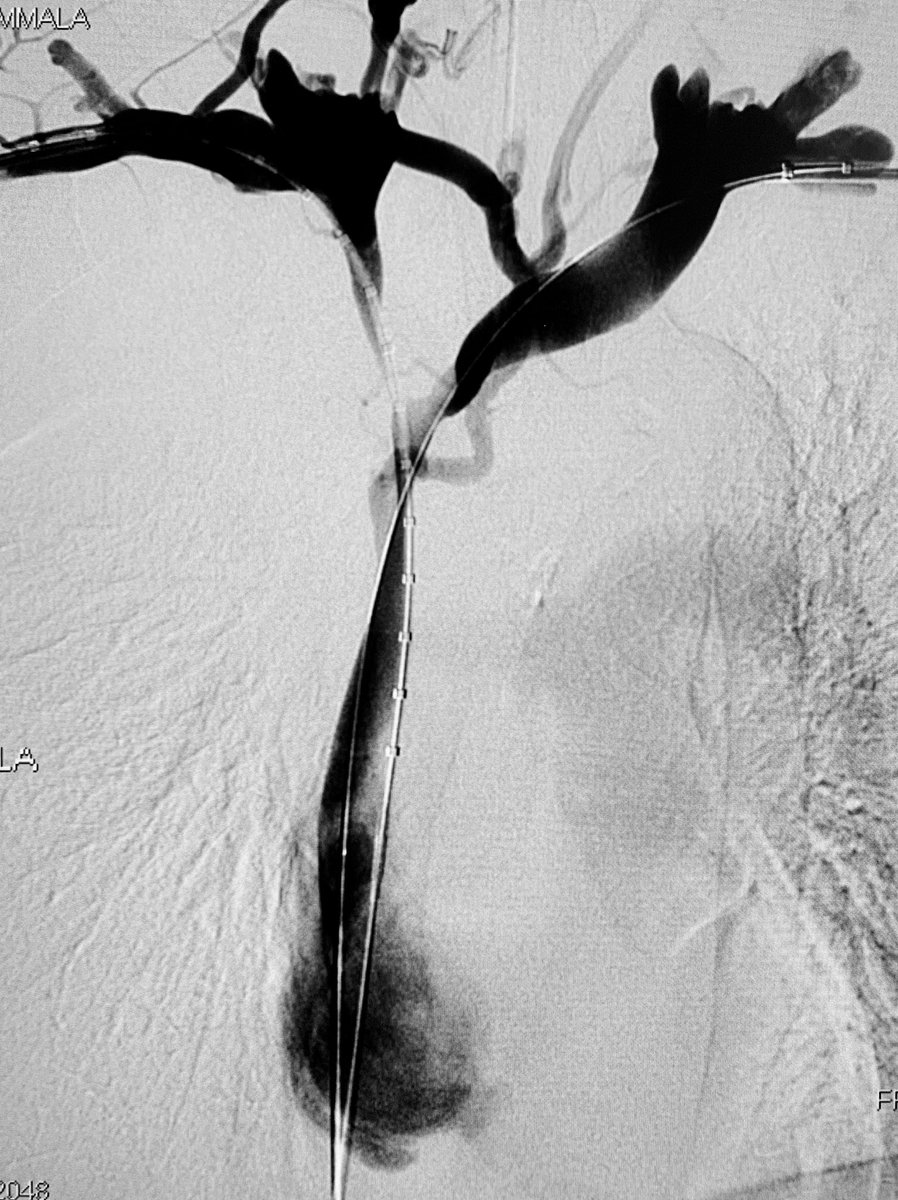 t_intheleadcoat's tweet photo. SVC syndrome due to invasive lung malignancy treated with kissing VBX stents. #irad #svcsyndrome #stentgraft #cancer #venogram #CTVO #swelling #palliation #VBX #pancoasttumor @womenirads @pairsmedia @io_meet @CIO_Oncology https://t.co/Lwj4WZwkkg