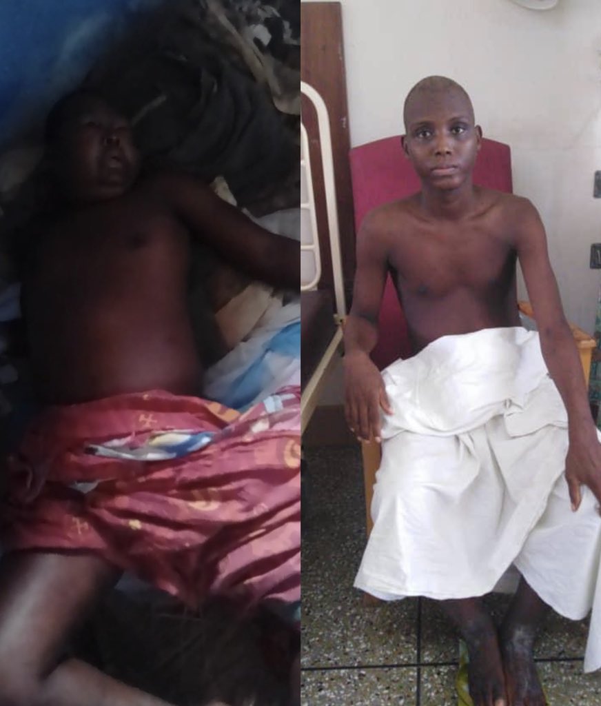 mimmyyeboah's tweet photo. This is Hubert, 21 years old. His family preparing for his death. His former doctors said he had kidney failure. The medicine prescribed to him wasn’t working. He was home day and night just swelling up for 6 months. They lost hope. https://t.co/ZKYRHZGT74