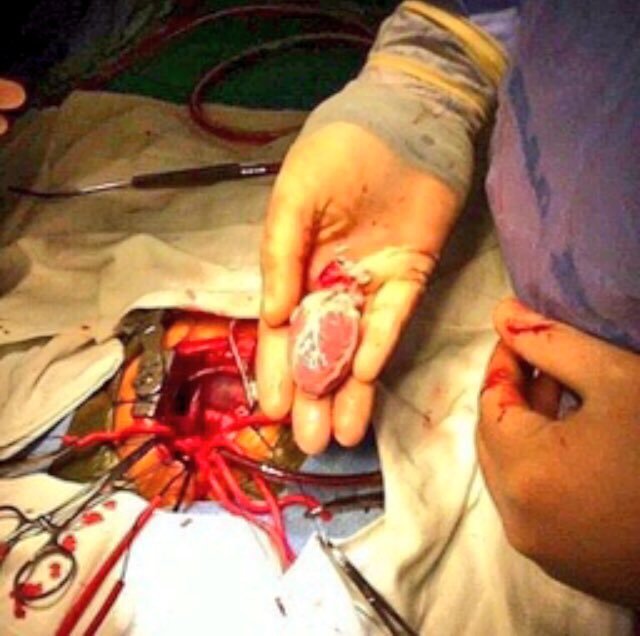 Hoy es el #DiaMundialDelCorazon, y si hay un órgano místico en el cuerpo, ese es el corazón. Durante mucho mucho tiempo, fue considerado el asiento del alma. Sus enfermedades, siguen siendo la primera causa de muerte en el mundo. En la foto, un corazoncito a punto del #trasplante